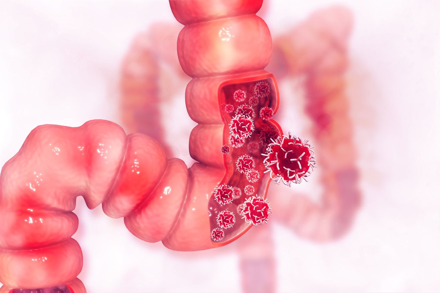 Prise prolongée d’antibiotiques : un risque accru de cancer du côlon selon une étude suédoise